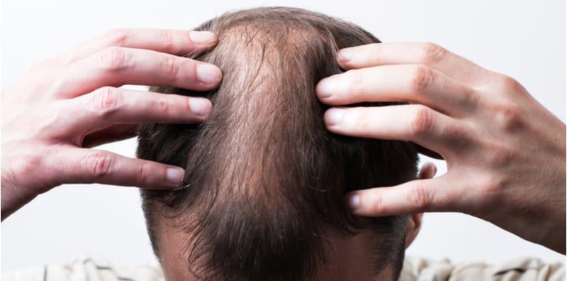 Masalah Botak & Rambut Beruban? Anda Berisiko Hidap Sakit Jantung