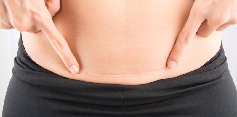 jangkitan-parut-czer