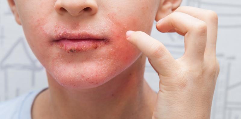 Bukan Alat Sulit Sahaja, Mulut Pun Boleh Dijangkiti HPV? Tolong Waspada 9 Tanda Ini!