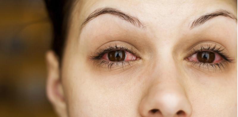 Bahaya Jika Alami Sakit Mata Sehingga Berdarah! Awasi 13 Puncanya (Termasuk Pakai Lensa)