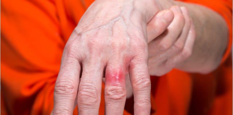 alergi-nikel-punca-gatal-besi