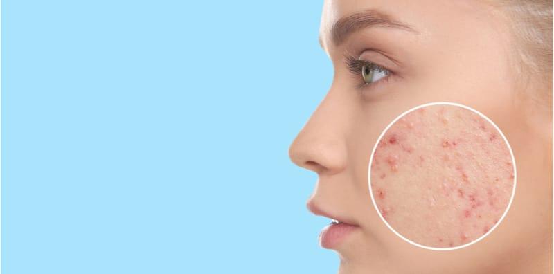 masalah-kulit-keadaan-usus