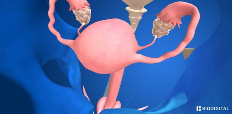 mengesan-kehamilan-pcos