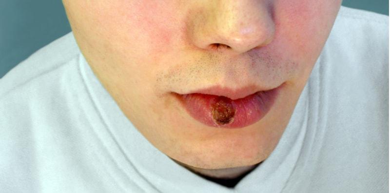 Muncul Ulser Pada Alat Sulit Itu Tanda Awal Sifilis, Apa Pula Simptom Sifilis Tahap Akhir?