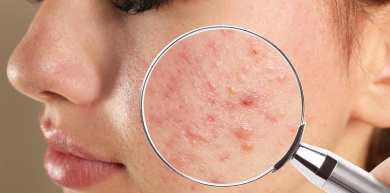 masalah-jerawat