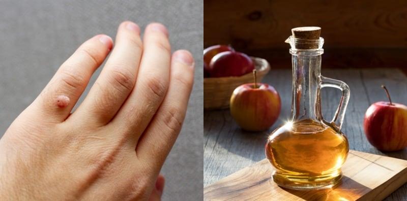 Malu Bila Ada Ketuat Dekat Badan, Cuba Hilangkannya Dengan Cuka Epal, Berkesan Ke?