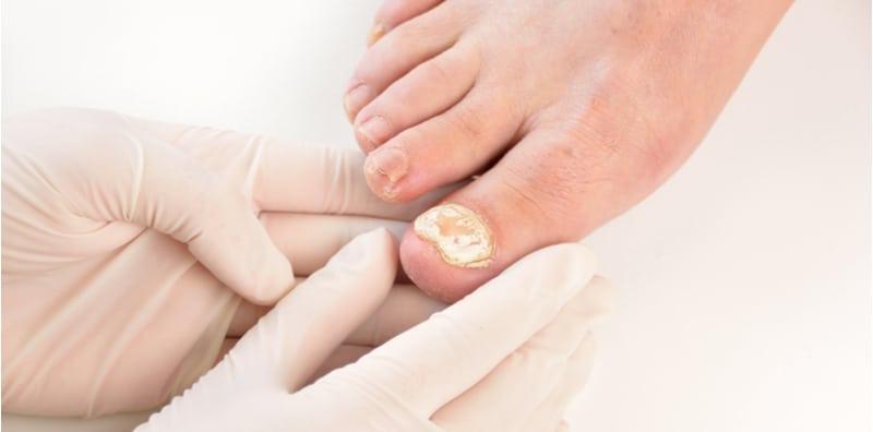 Malu Nak Tunjuk Kaki Bila Ada Kulat Kuku, Usah Risau, Ini Cara Berkesan Untuk Merawatnya!