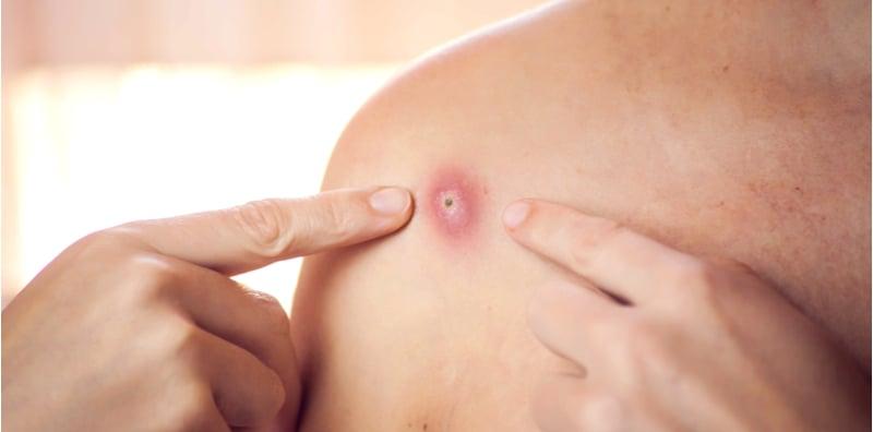 Ada Bisul Di Badan? Jangan Picit! Ini Cara Hilangkan Tanpa Tinggal Parut