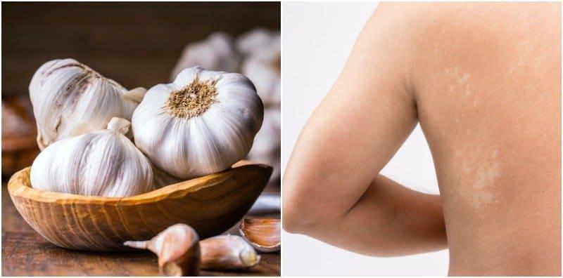 4 Kaedah Tradisional Ini Katanya Boleh Hilangkan Panau, Berkesan Ke?