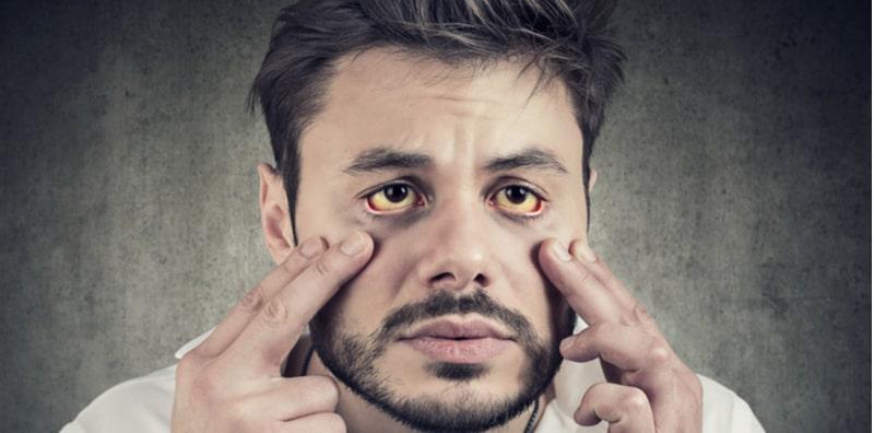 Bukan Hanya A & B Sahaja, Tahukah Anda Hepatitis Sebenarnya Ada 5 Jenis?