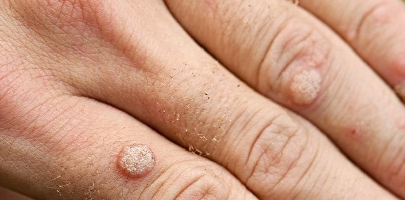 merawat-ketuat-tangan-kaki