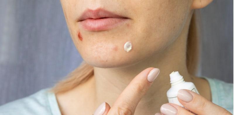 Rawat Jerawat Dengan Produk Berasaskan Tretinoin, Ikut Cara Pakai Ini, Barulah Berkesan!