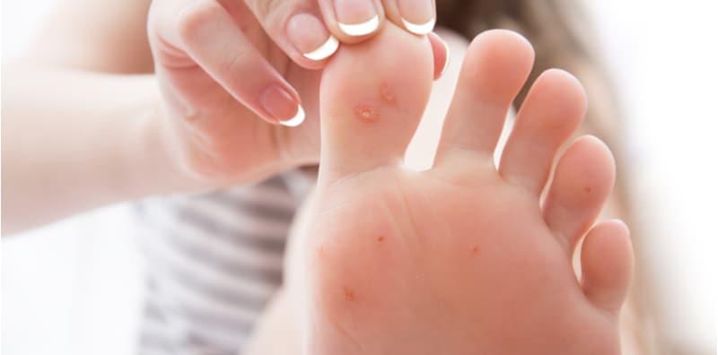 masalah-kulit-ketuat