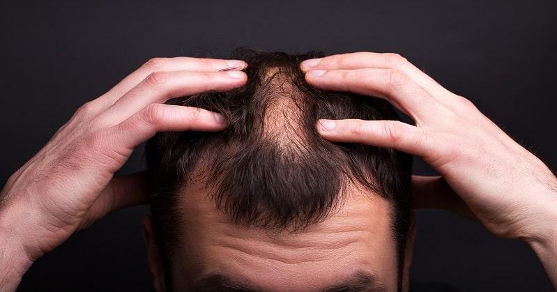 Mengapa Lelaki Lebih Berisiko Jadi Botak? Ini 5 Cara Kawal Hormon Elak Rambut Gugur