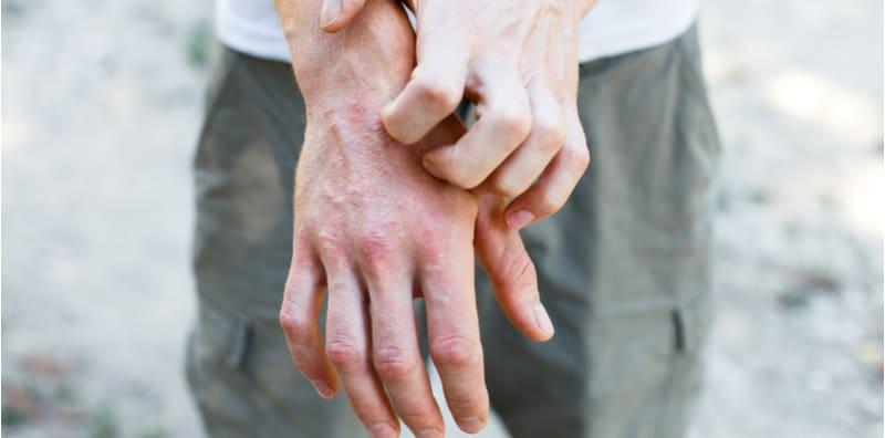 beza-dermatitis-atopik-ekzema