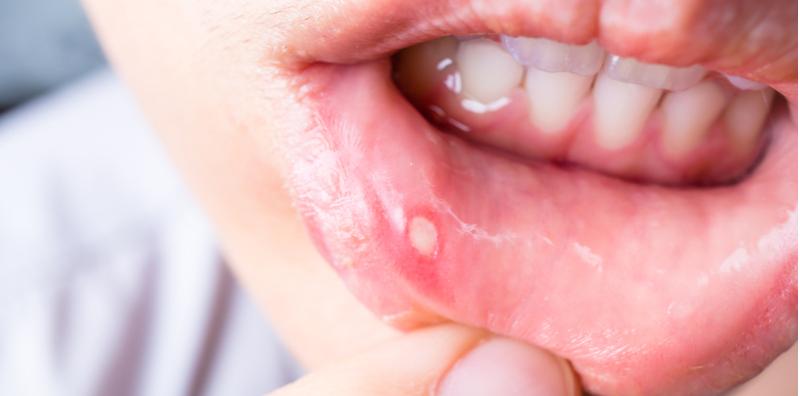 Jangan Terus Sapu Ubat Gel Jika Terkena Ulser Mulut, Lagi-lagi Pada Anak Kecil! Ini Sebabnya