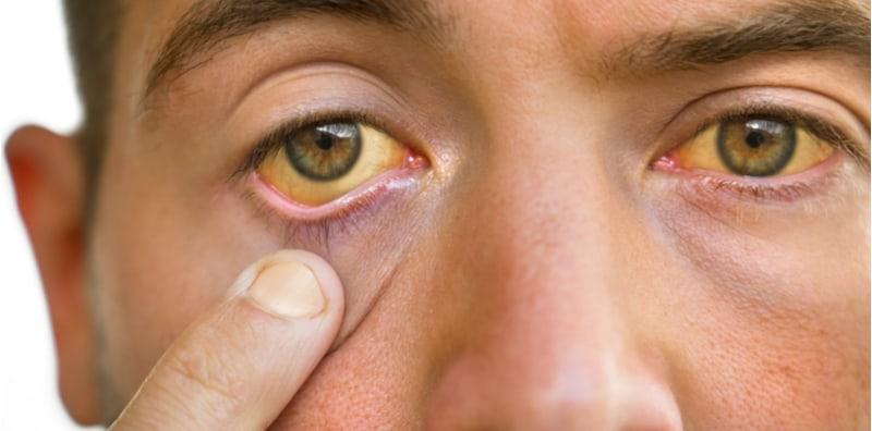 Mata Kuning Sebab Jaundis? Bukan Saja Berlaku Pada Bayi, Tapi Juga Kanak-kanak & Orang Dewasa