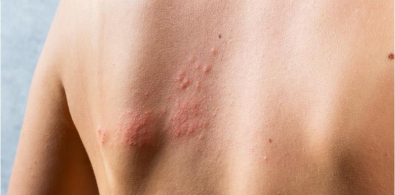 Ini 7 Punca Badan Naik Bintik Merah, Jangan Biarkan!