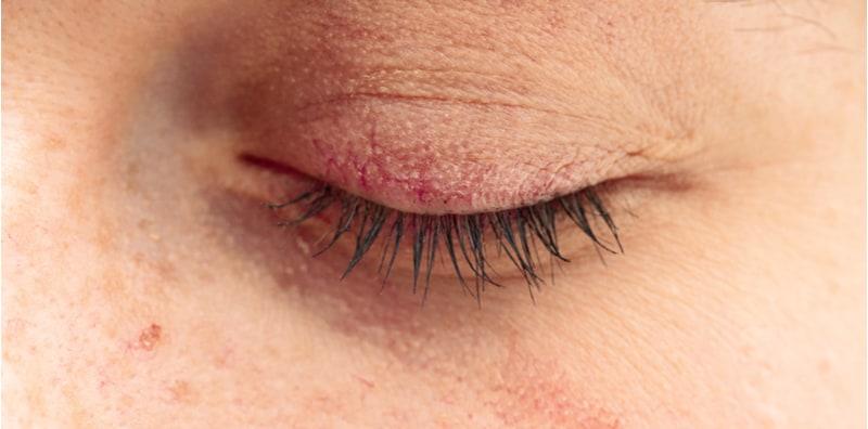 kelopak-mata-gatal-dan-kering-dermatitis