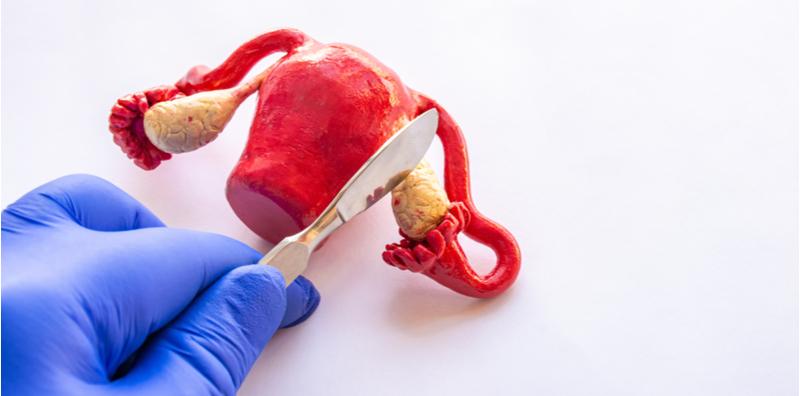 pembedahan-buang-barah-ovari