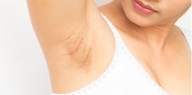 ketiak-hitam-saat-hamil-atasi