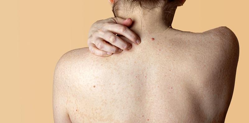 Penyakit Jangkitan Kulit: Jenis, Punca & Rawatan