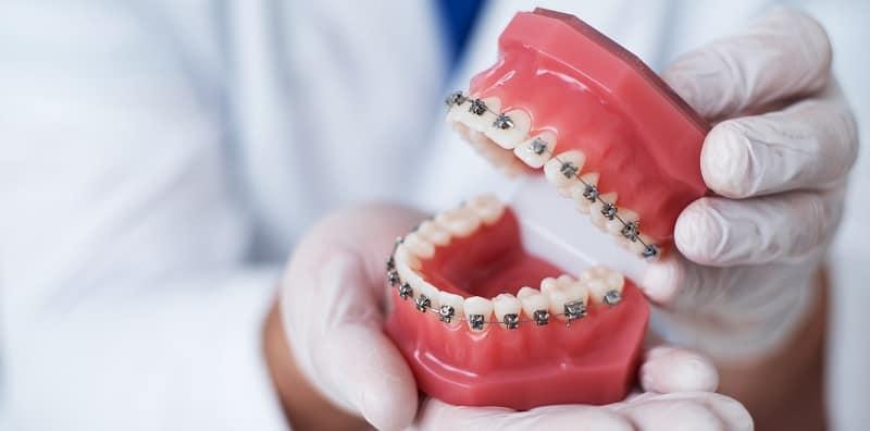 Jangan Abaikan Kesihatan Gigi! Ini 8 Masalah Ortodontik Yang Lazim Berlaku