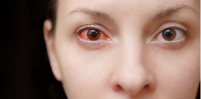 Ini Cara Merawat Sakit Mata Dengan Betul, Jangan Biar Berlanjutan!