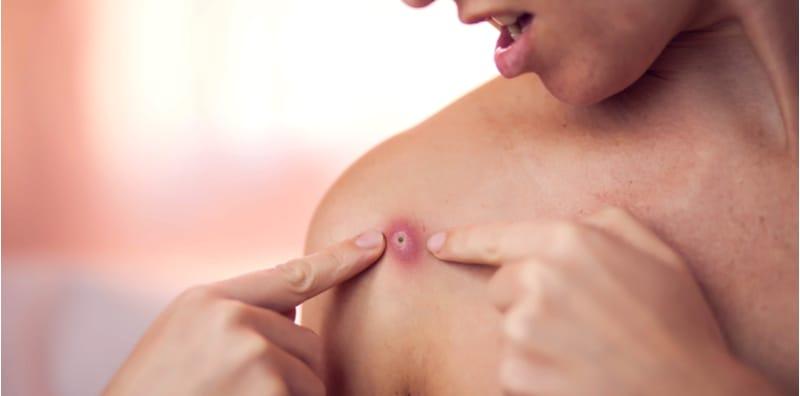 Bisul Di Anggota Badan, Jangan Gatal Tangan Nak Picit Ya! Ambil Tahu Punca & Gejalanya