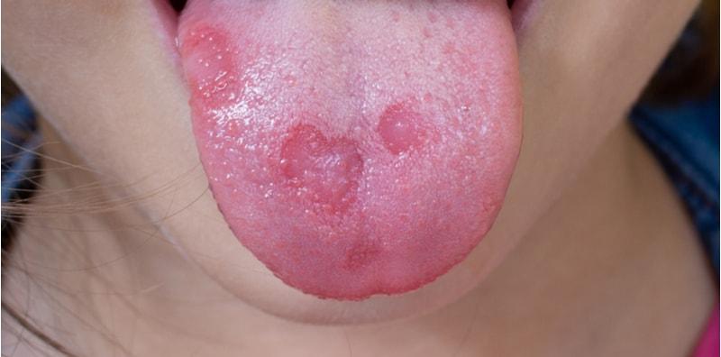 cara-menghilangkan-ulser-gerd