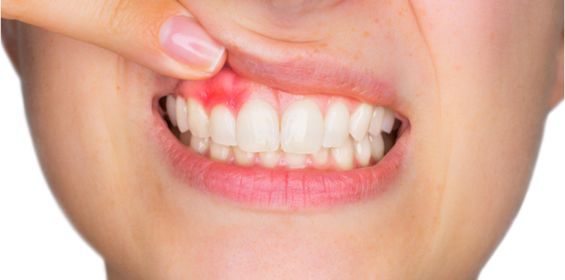 Penyakit Gusi & Mulut (Gingivitis & Periodontitis)