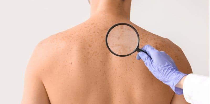 Masa Untuk Periksa Kulit Anda! Ini Gejala Bagi 4 Jenis Kanser Kulit Yang Boleh Ancam Nyawa
