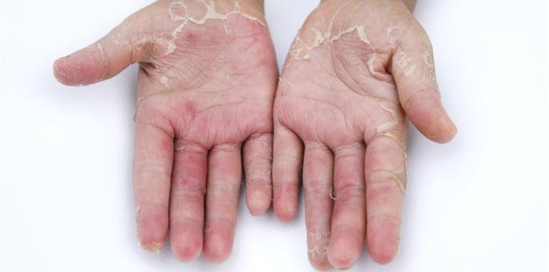 AWAS, Tangan Kering & Mengelupas Mungkin Petanda Masalah Kulit! Ini 4 Penyebab Utama