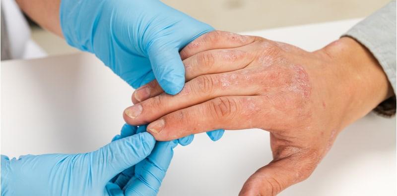 Ekzema, Alahan Makanan Dan Dermatitis Atopik - Apa Kaitannya Antara 3 Penyakit Ini?