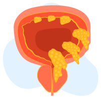 Kanser Pundi Kencing