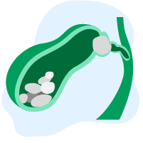 Penyakit Pundi Hempedu