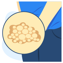 Herpes Kemaluan dan Oral