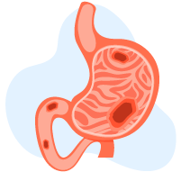 Penyakit Ulser Peptik