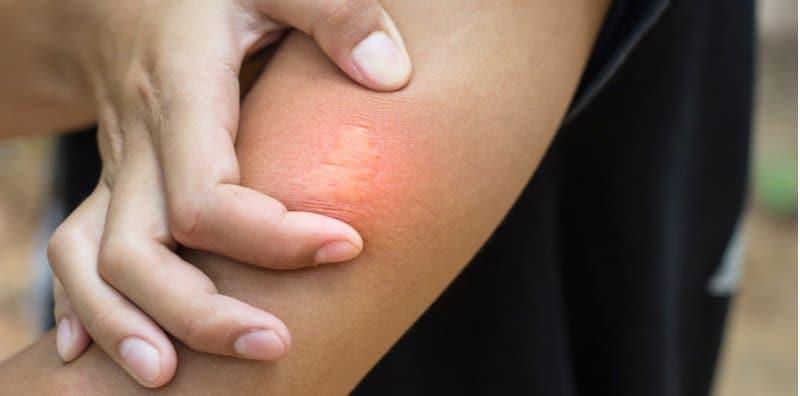 Bantuan Kecemasan Jika Kena Sengat Lebah! Ikut Langkah Ini