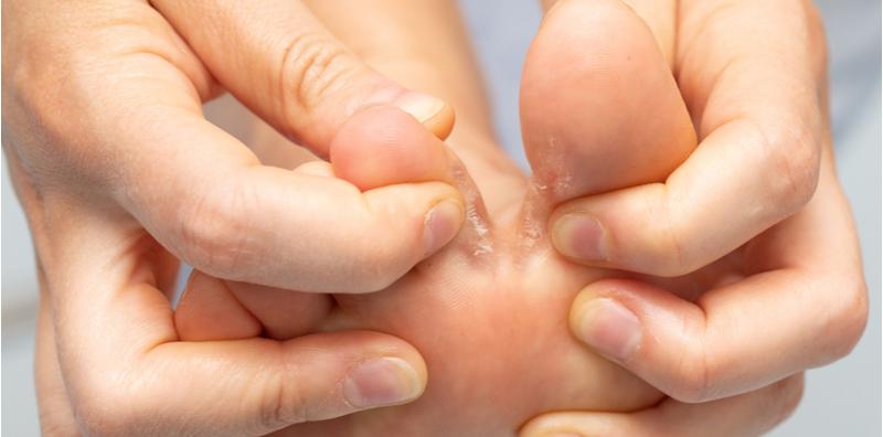 Celah Jari Kaki Mengelupas? Ini Namanya Kulat Air! Rawatnya Dengan 6 Cara Ini