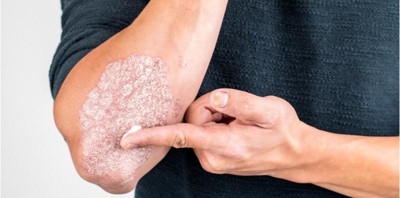 ubat-psoriasis