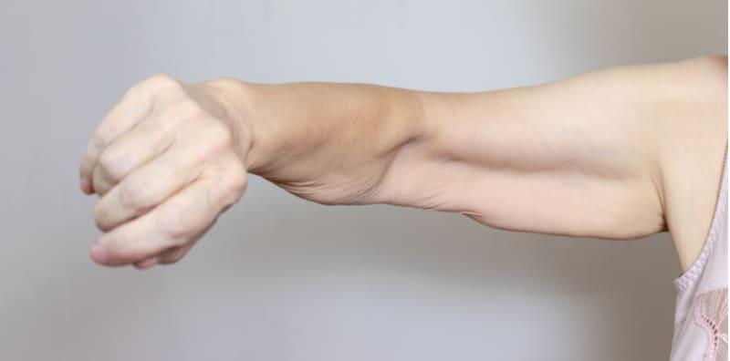 Ini Cara Menganjalkan Kulit Selepas Berjaya Turunkan Berat Badan!