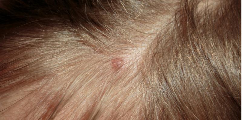kulit-kepala-gatal
