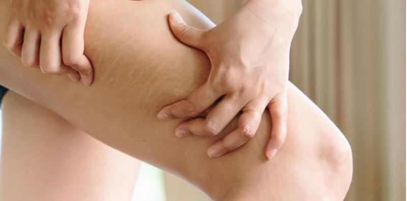 Susah Nak Hilangkan Stretch Marks Di Paha? Cuba 2 Cara Mudah Ini, Pasti Berjaya!
