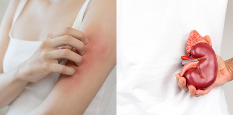 Mata Sembap & Kulit Gatal Antara Tanda Masalah Buah Pinggang, Periksa 6 Gejala Bahaya Lain!