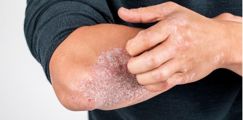 Hati-Hati 4 Jenis Ubat Ini Boleh Menjadi Punca Sakit Kulit Psoriasis Bertambah Teruk!