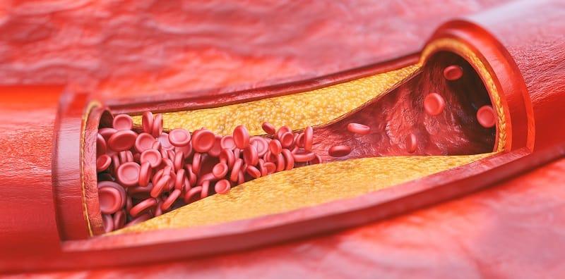 Aterosklerosis: Info Lengkap Di Sini