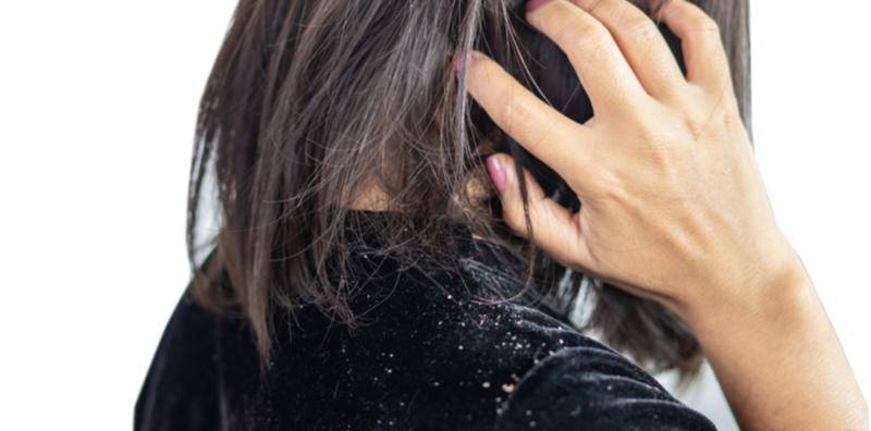 Kelemumur Dan Psoriasis Kulit Kepala: Nampak Sama, Tapi Tak Serupa! Ini Bezanya