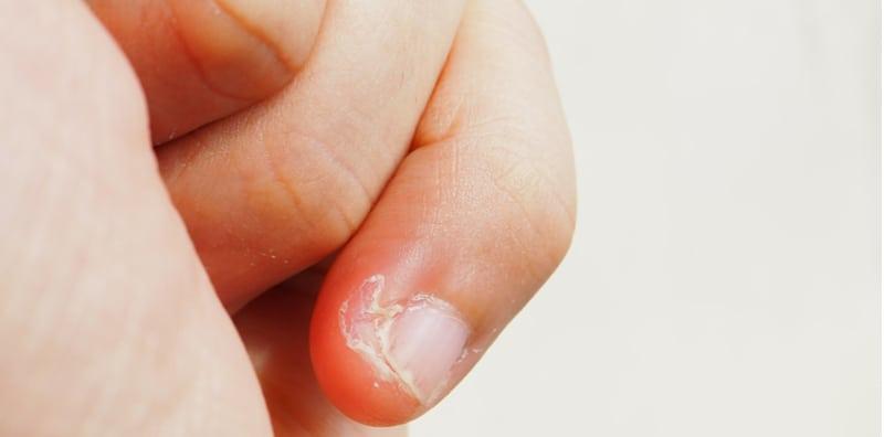 kulit-jari-mengelupas-kuku