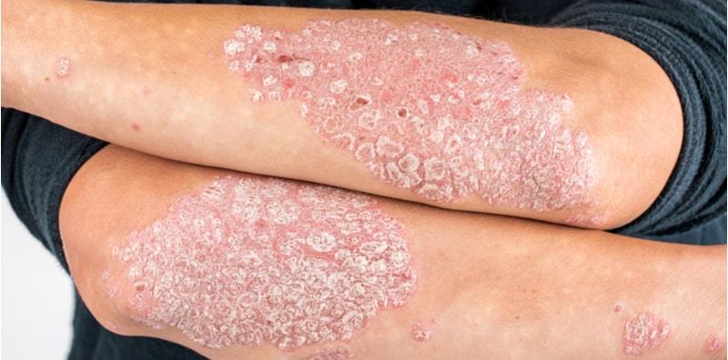Psoriasis, Bukan Sekadar Penyakit Kulit!